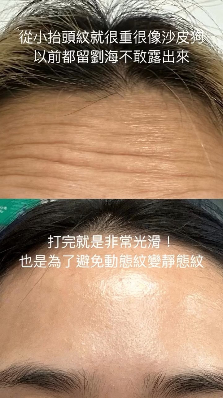網紅Una施打肉毒桿菌素改善抬頭紋BA
