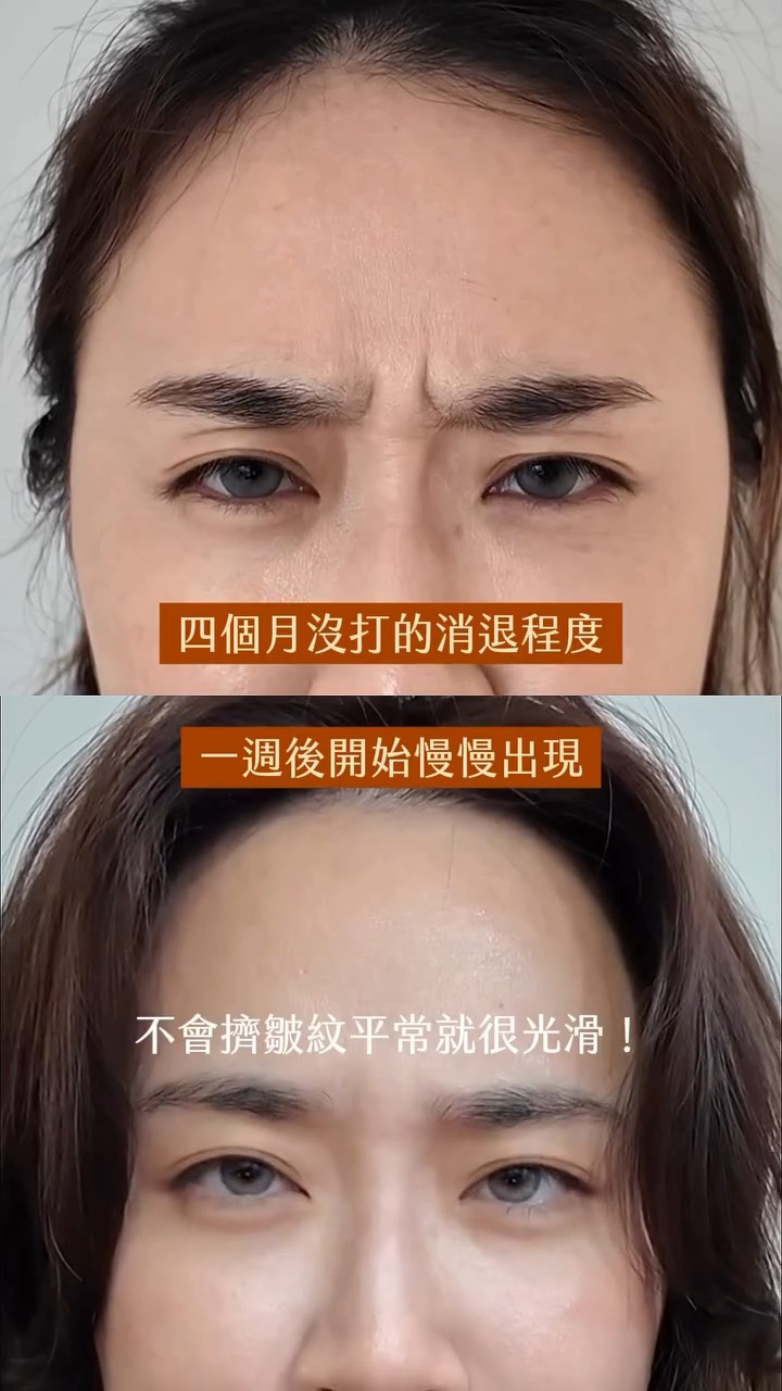 網紅Una施打肉毒桿菌素改善皺眉紋BA