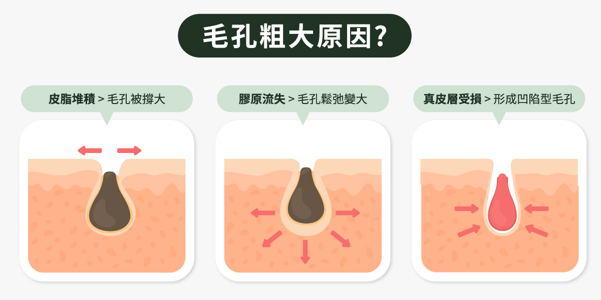 毛孔粗大原因