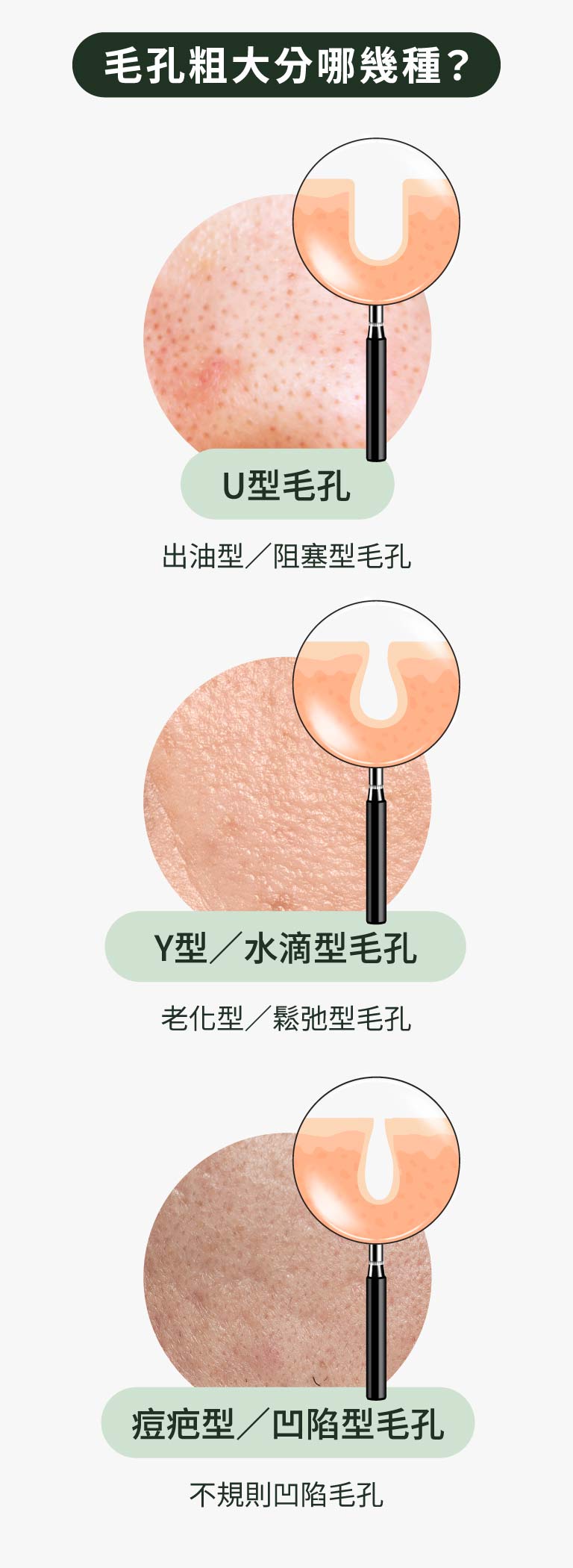 毛孔粗大分哪幾種
