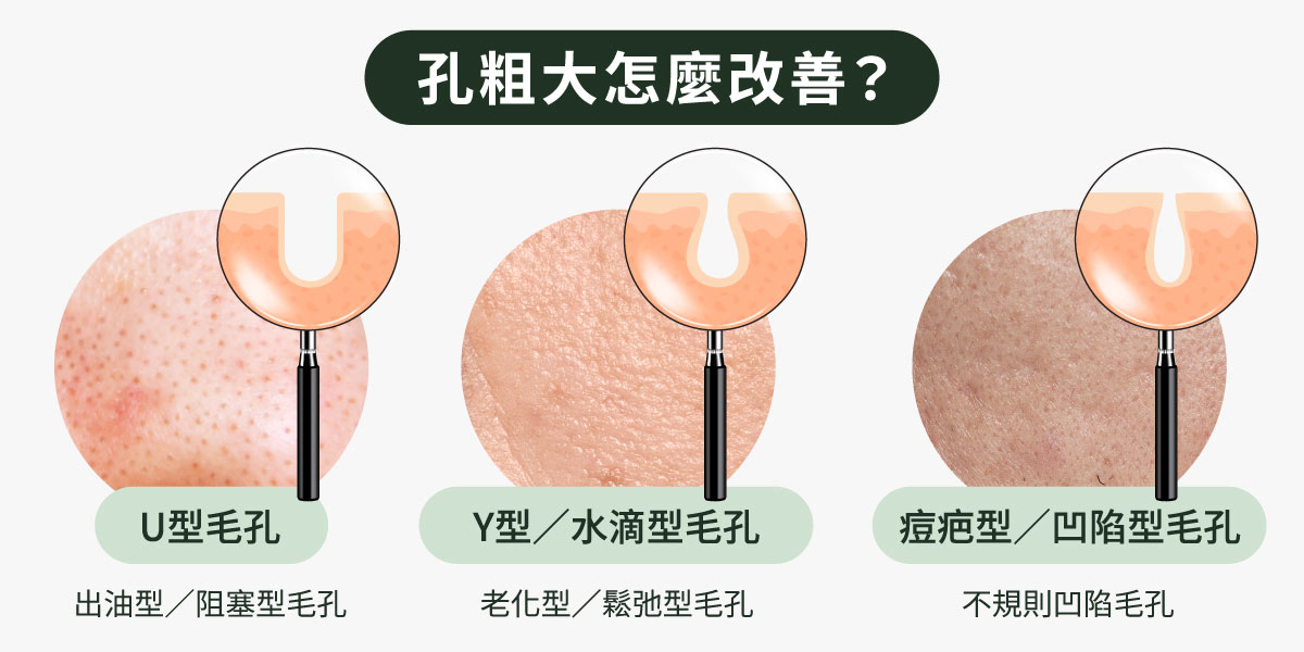 毛孔粗大分哪幾種
