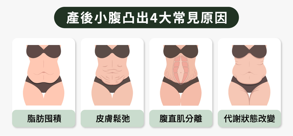 產後小腹凸出4大常見原因