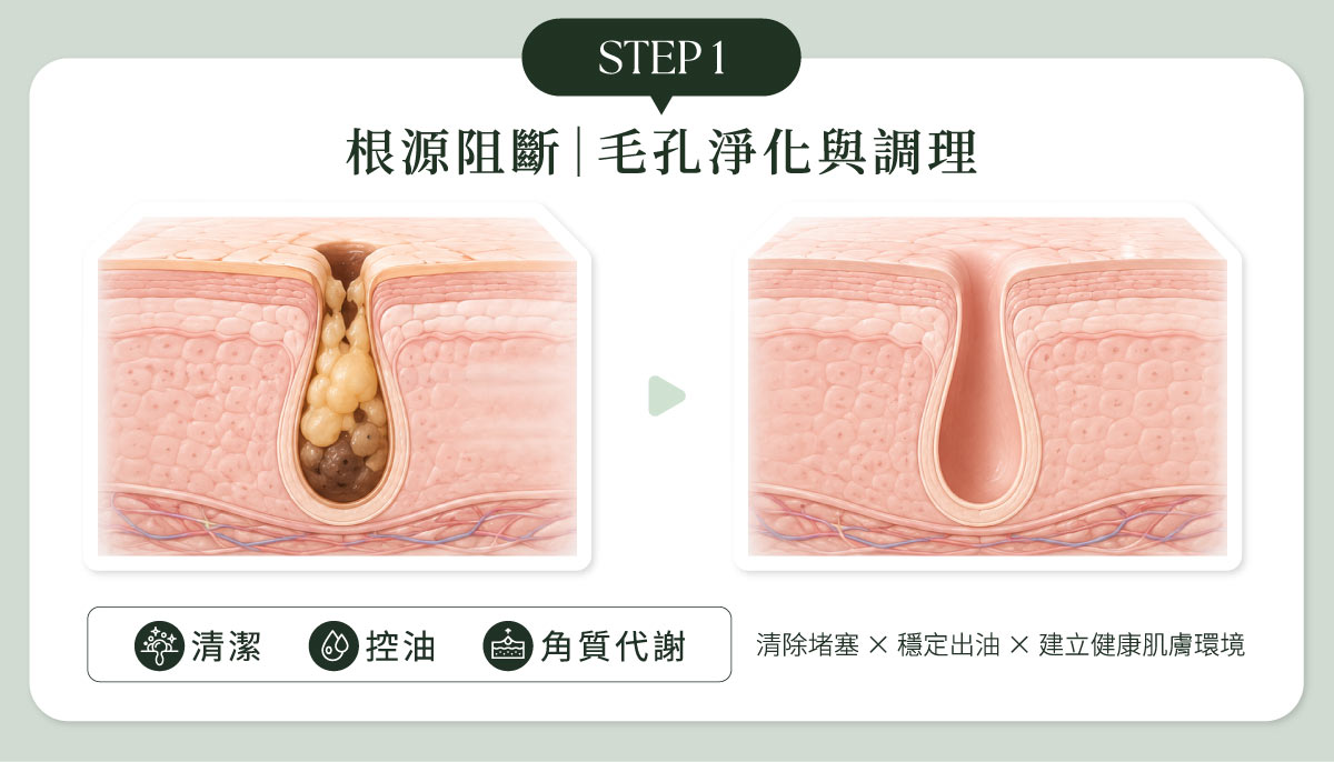 毛孔粗大改善STEP1：根源阻斷｜毛孔淨化與調理 概念：把塞住的毛孔打開