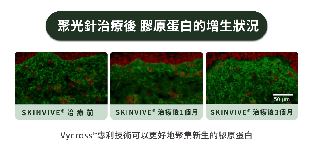 聚光針治療後 膠原蛋白的增生狀況