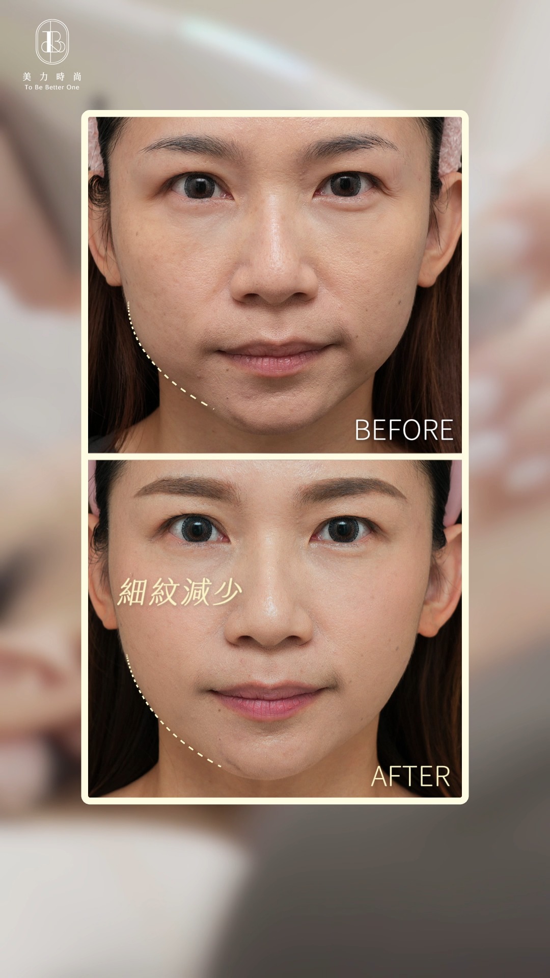 美力時尚診所案例：韓音雙波BA_改善輪廓線、眼周細紋、眼周拉提
