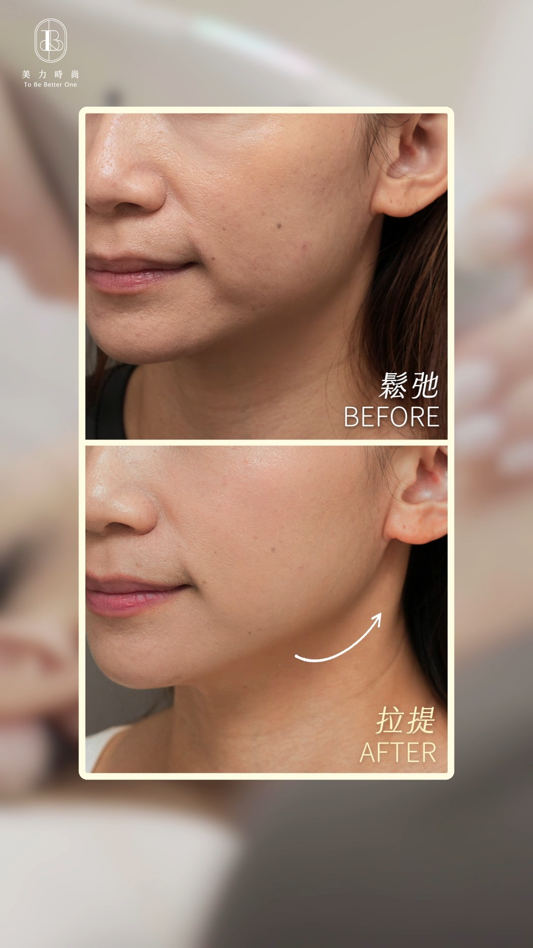 美力時尚診所案例：韓音雙波BA_改善輪廓線、嘴邊肉