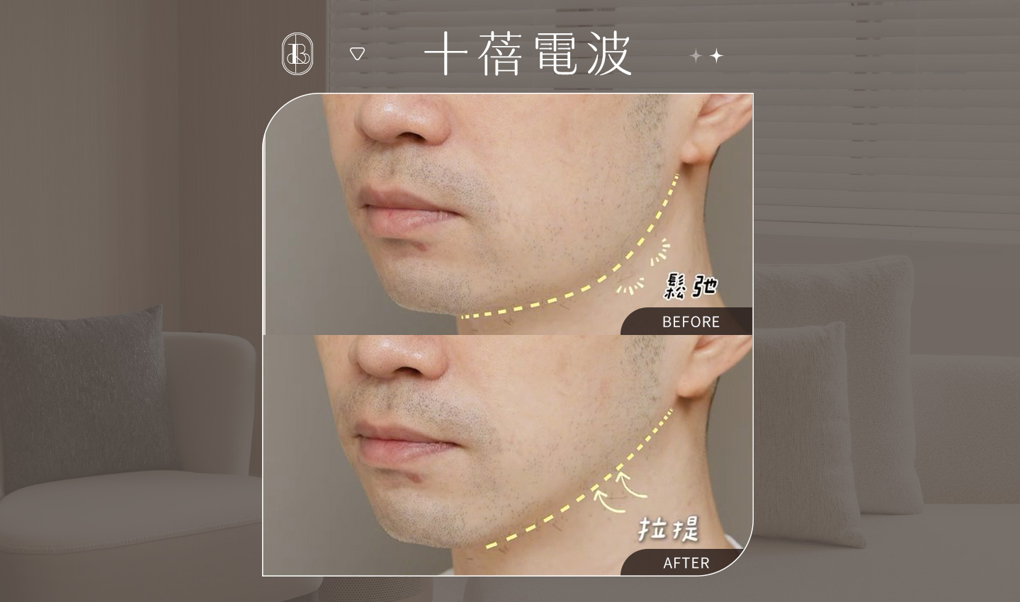 美力時尚診所案例：十蓓電波BA 男性俐落輪廓線