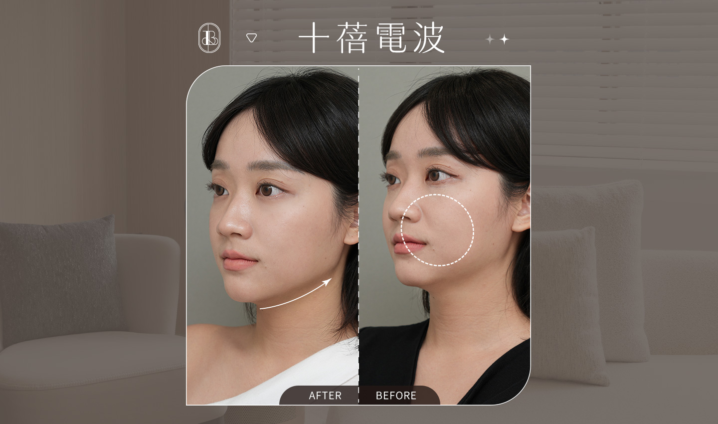 美力時尚診所案例：十蓓電波BA