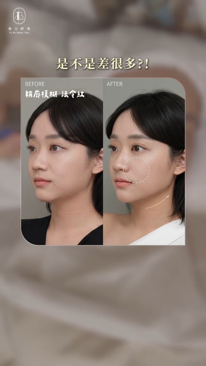美力時尚診所案例：十蓓電波-改善法令紋、輪廓線BA