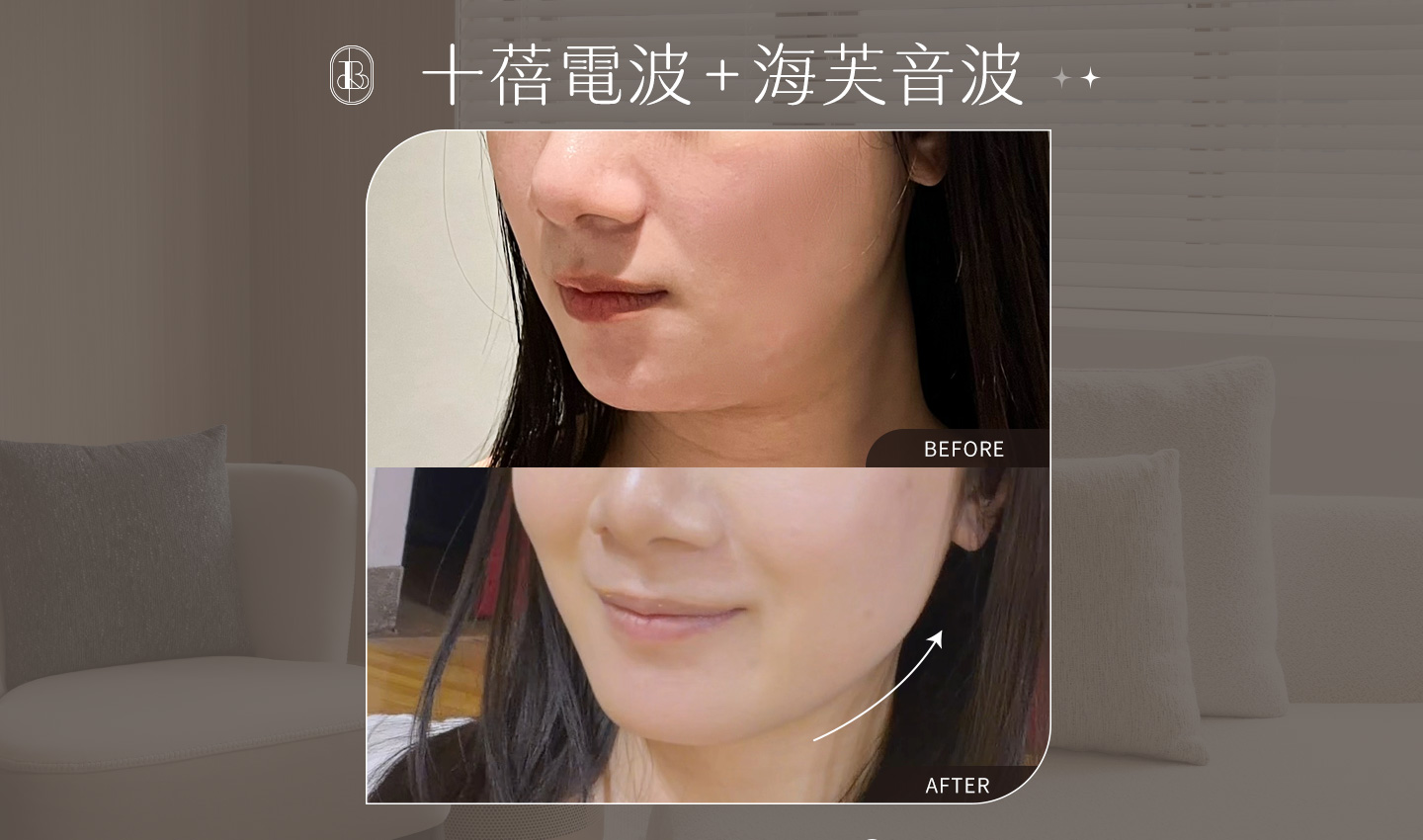 美力時尚診所案例：網紅《Krystal》體驗十蓓電波&海芙音BA
