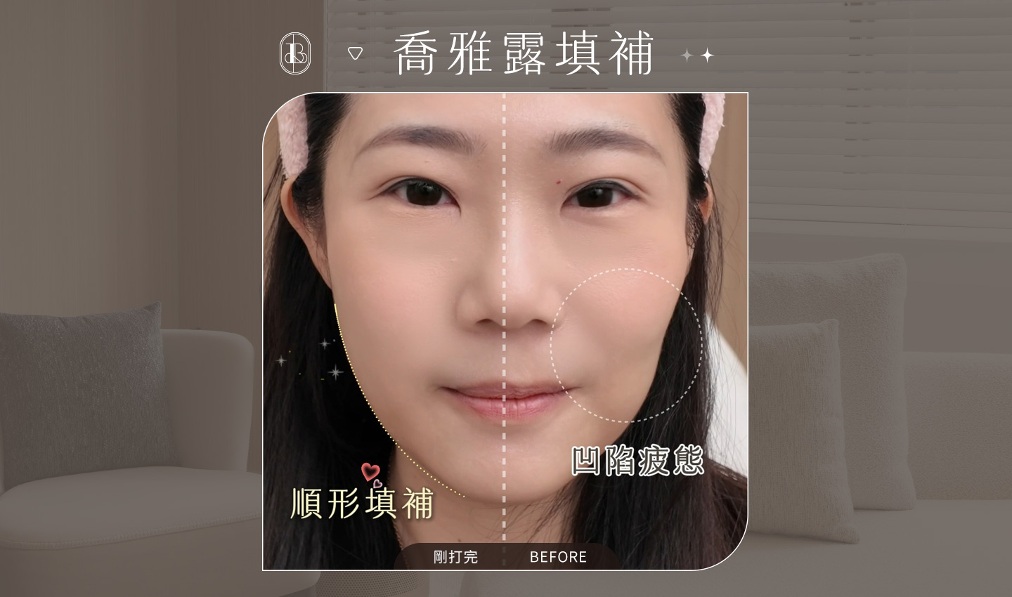 美力時尚診所案例：喬雅露填補頰凹、輪廓線BA