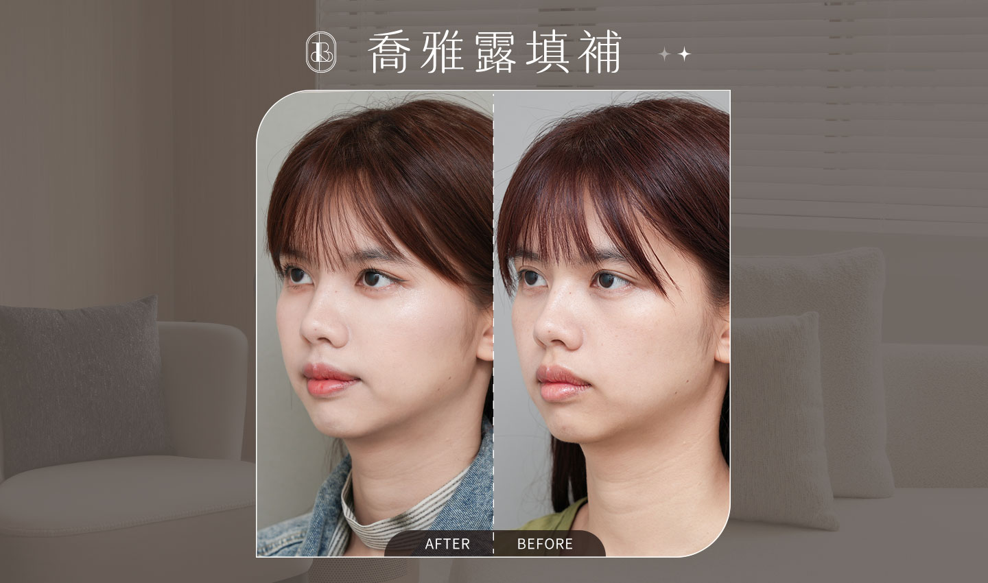 美力時尚診所案例：喬雅露填補蘋果肌、淚溝BA