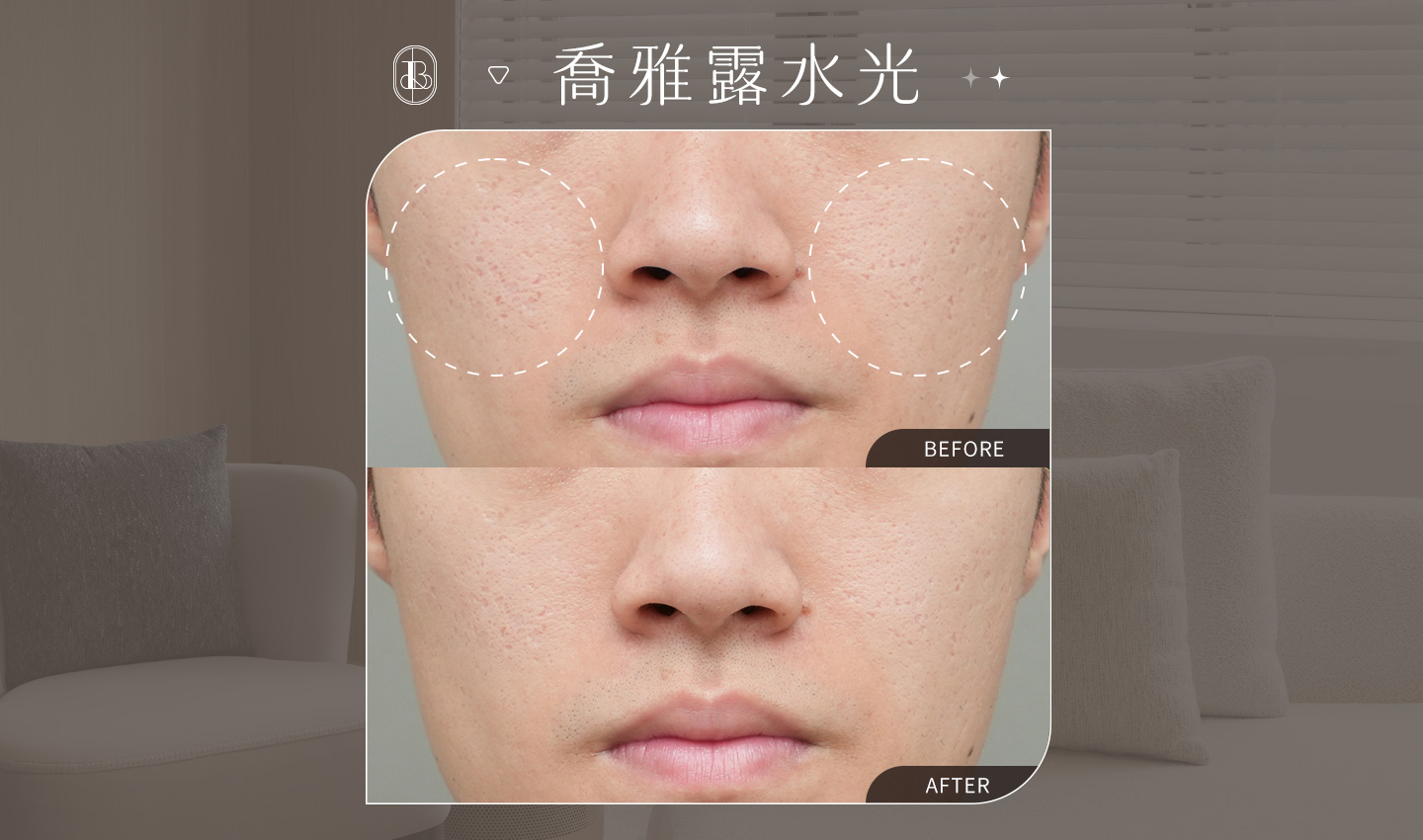 美力時尚診所案例：喬雅露水光BA