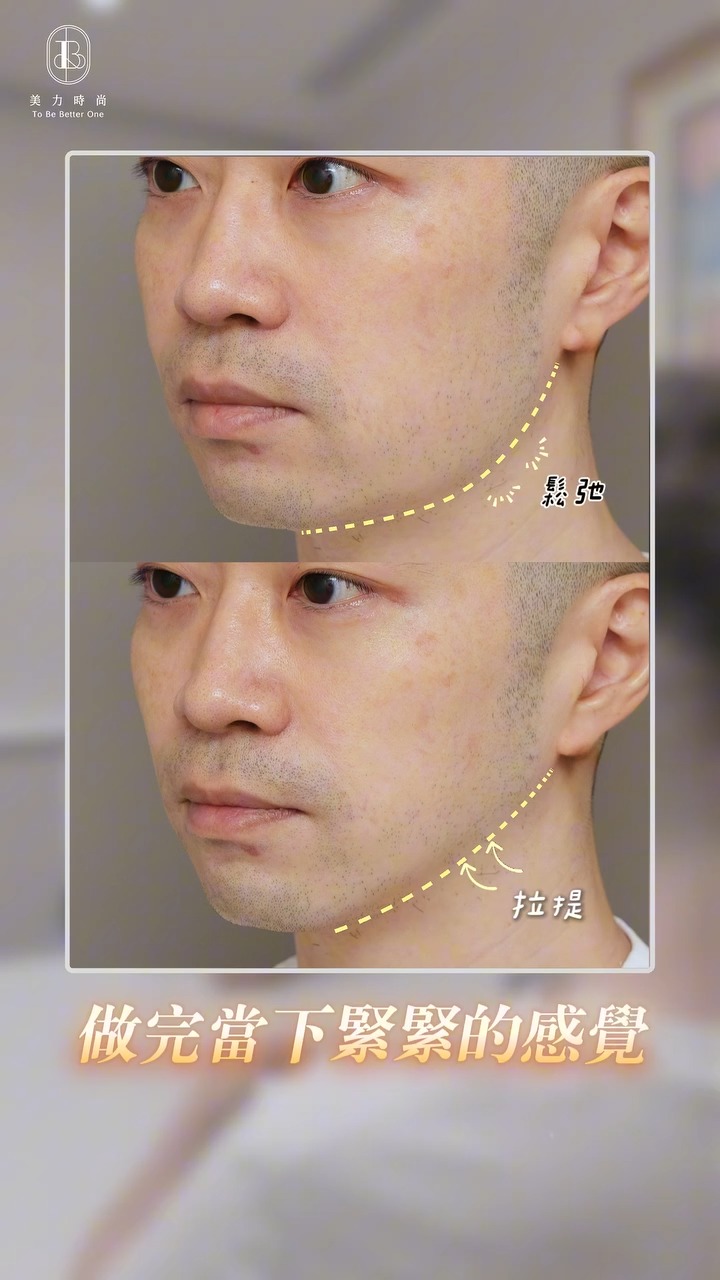 美力時尚診所案例：十蓓電波BA_側臉