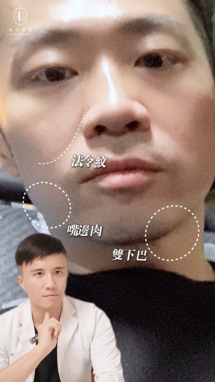 男性臉部困擾:法令紋、嘴邊肉、雙下巴