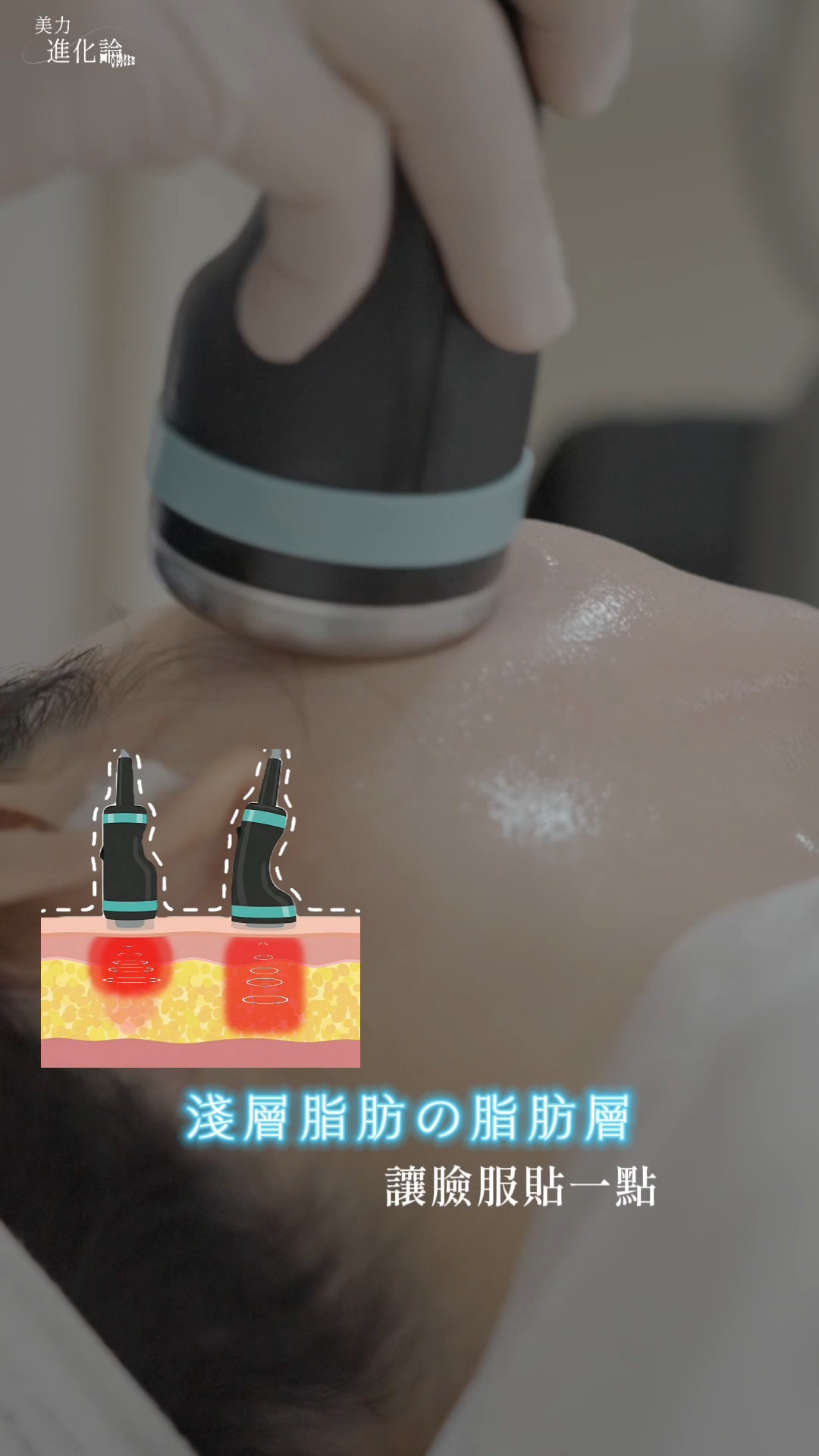 施打onda pro畫面_針對淺層脂肪消脂