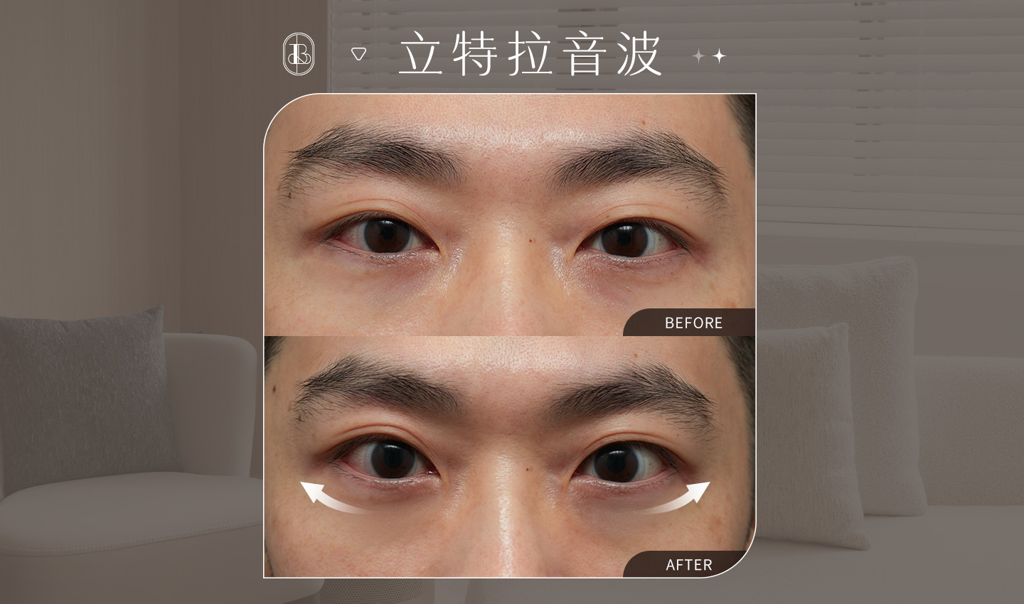 美力時尚診所案例：立特拉眼周音波BA