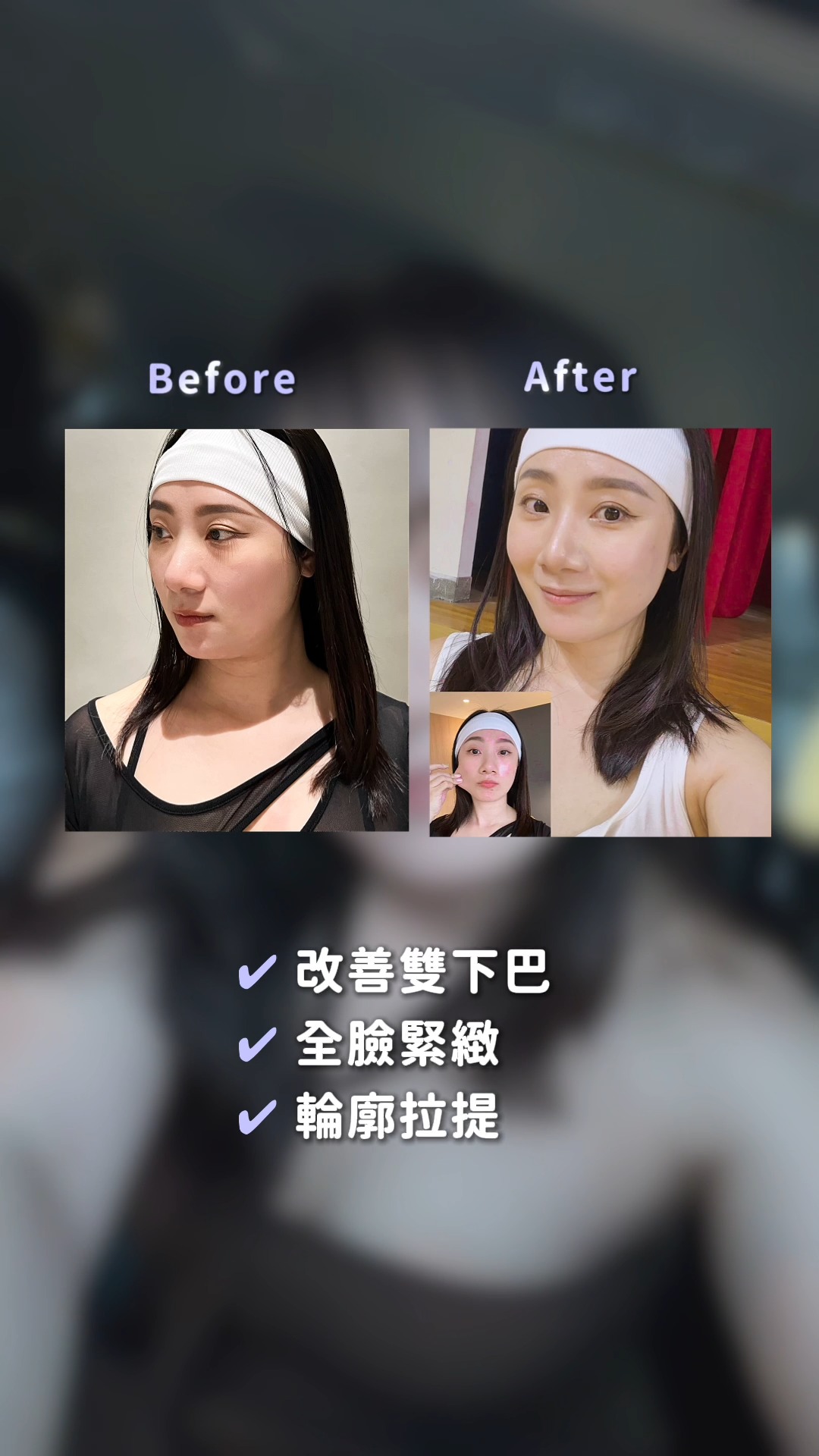 網紅《Krystal》電音波真實分享-施打後BA