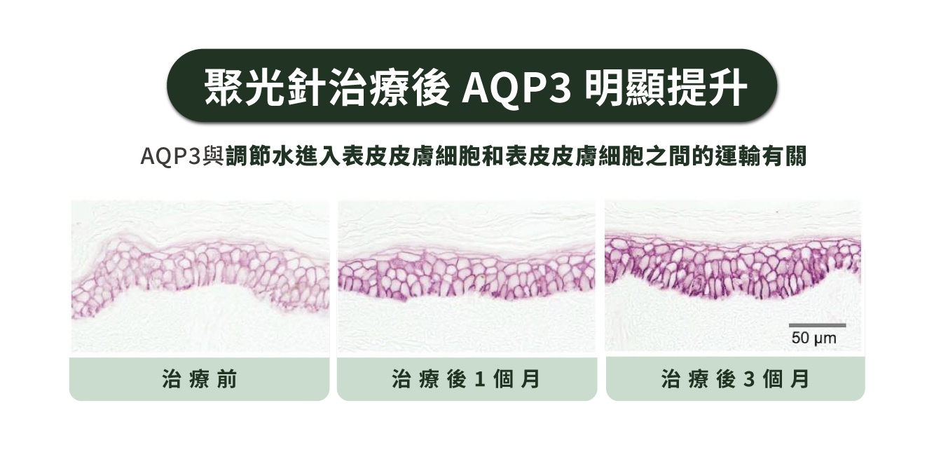 聚光針治療後 AQP3 明顯提升