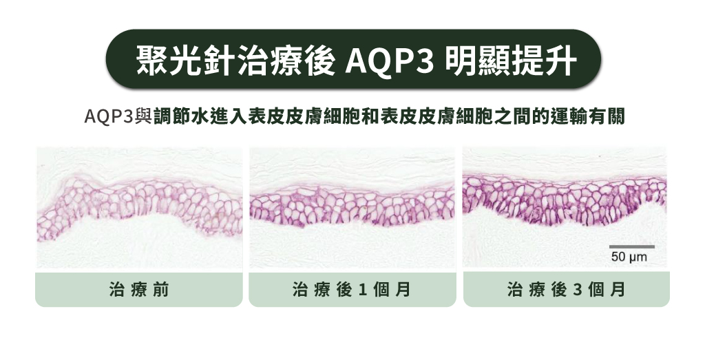聚光針治療後 AQP3 明顯提升
