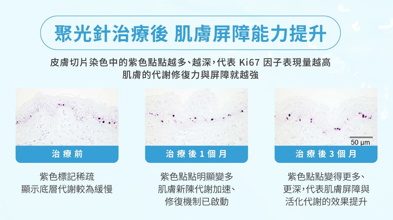 聚光針治療後 肌膚屏障能力提升