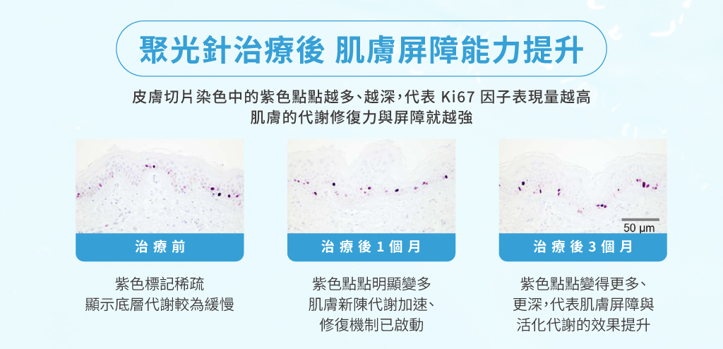 聚光針治療後 肌膚屏障能力提升