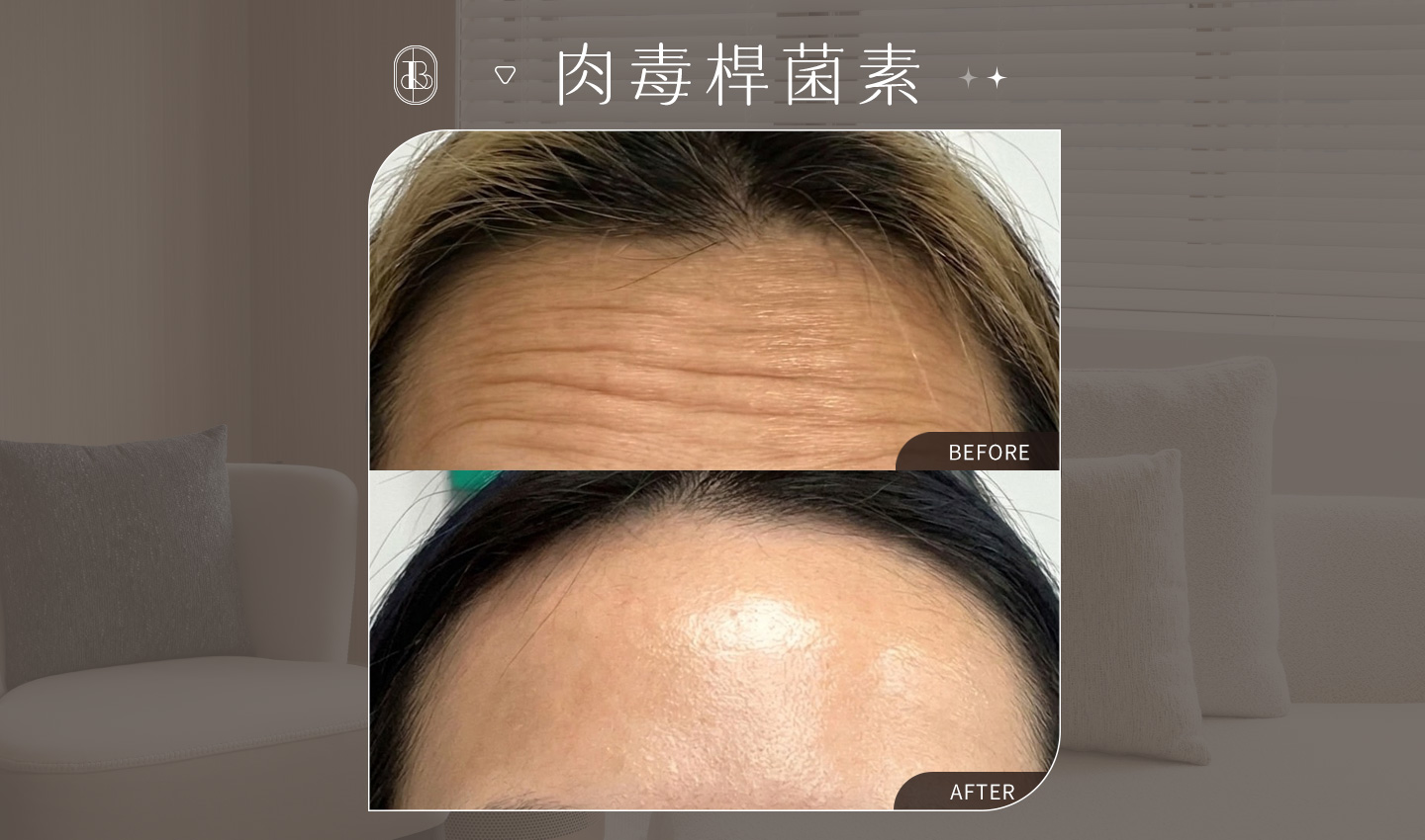 美力時尚診所，KOL UNA見證-抬頭紋注射肉毒改善案例