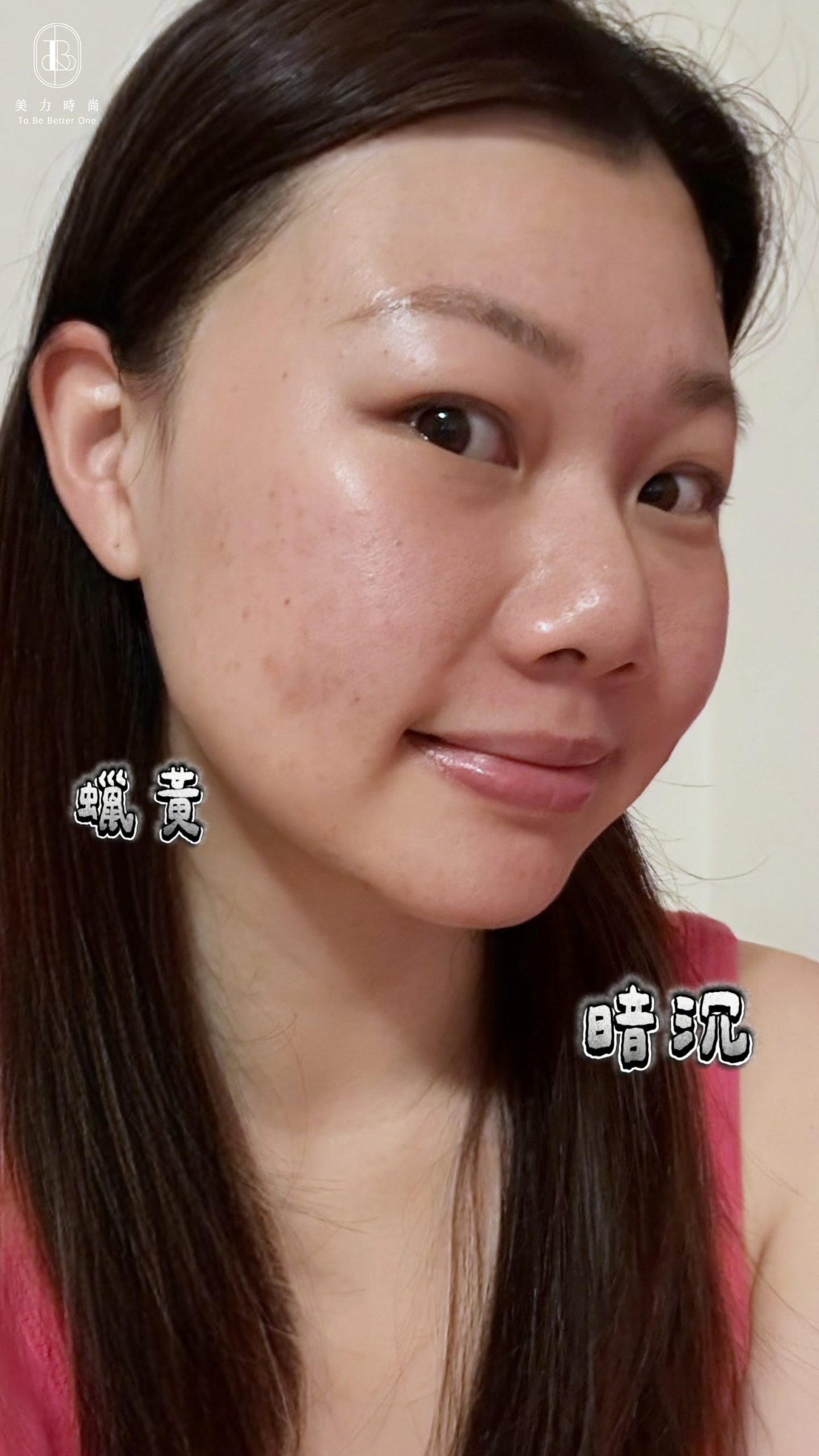 ANN肌膚困擾