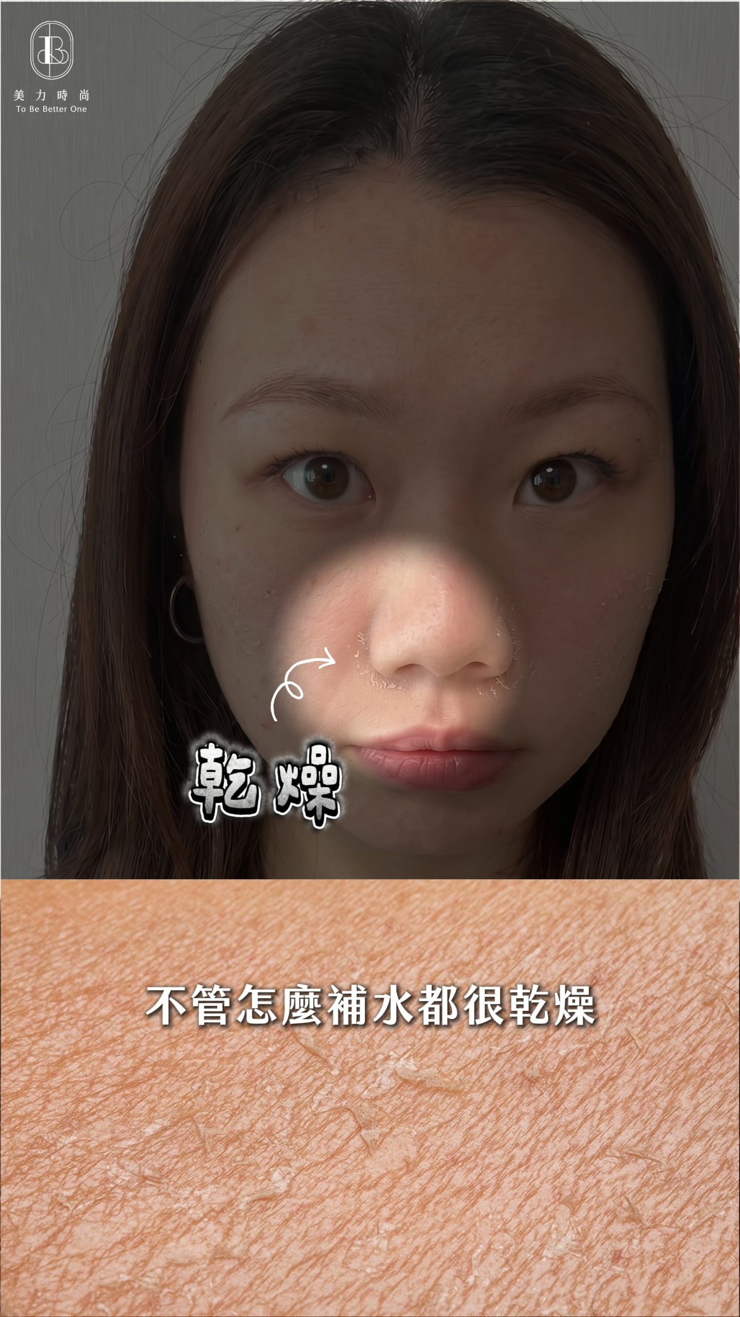 ANN肌膚困擾