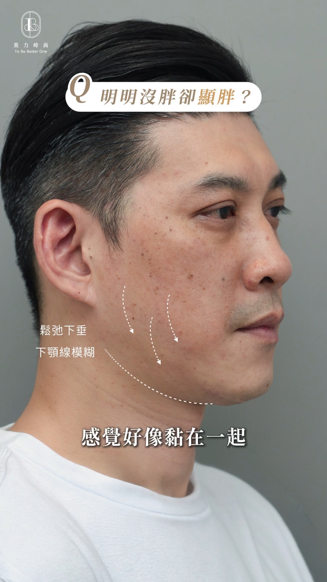 Johnny臉部困擾_臉部鬆弛下垂、下顎線模糊