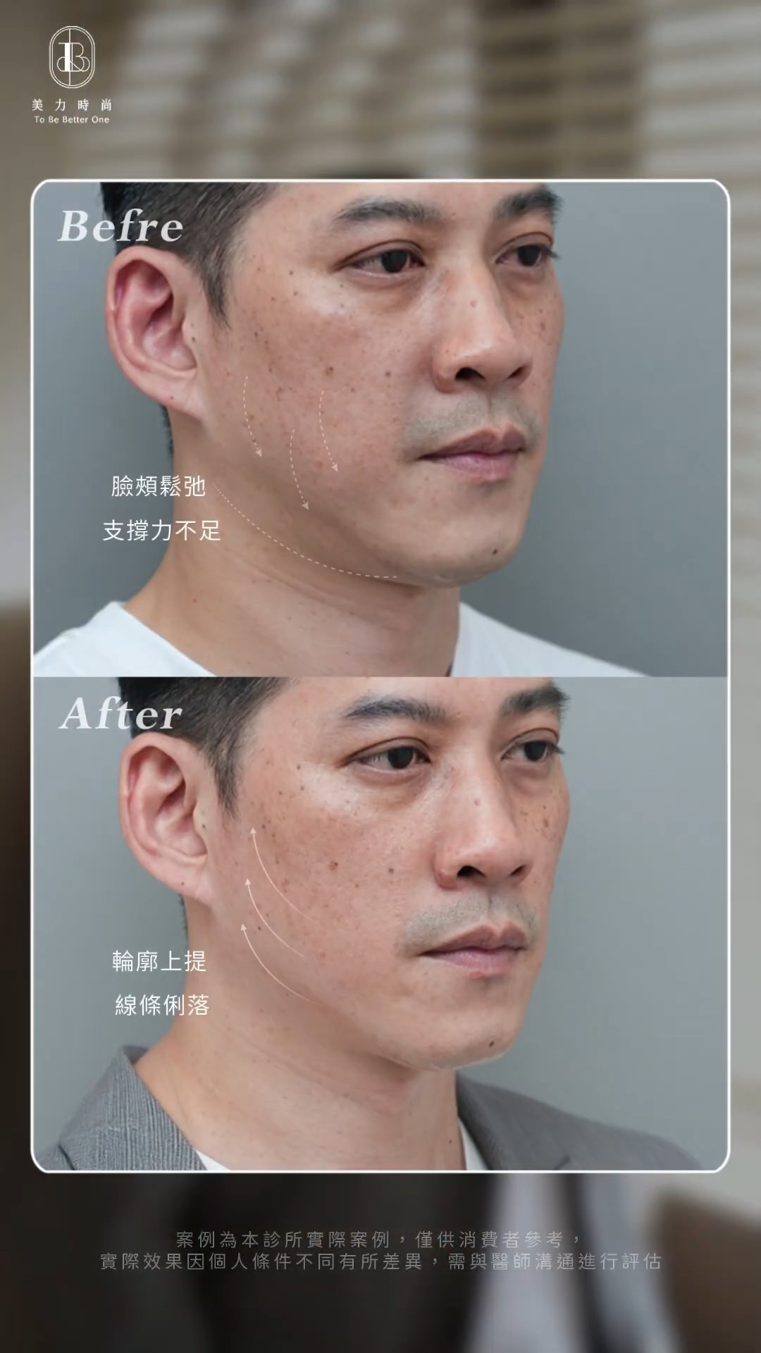 美力時尚診所案例：Johnny電音波BA