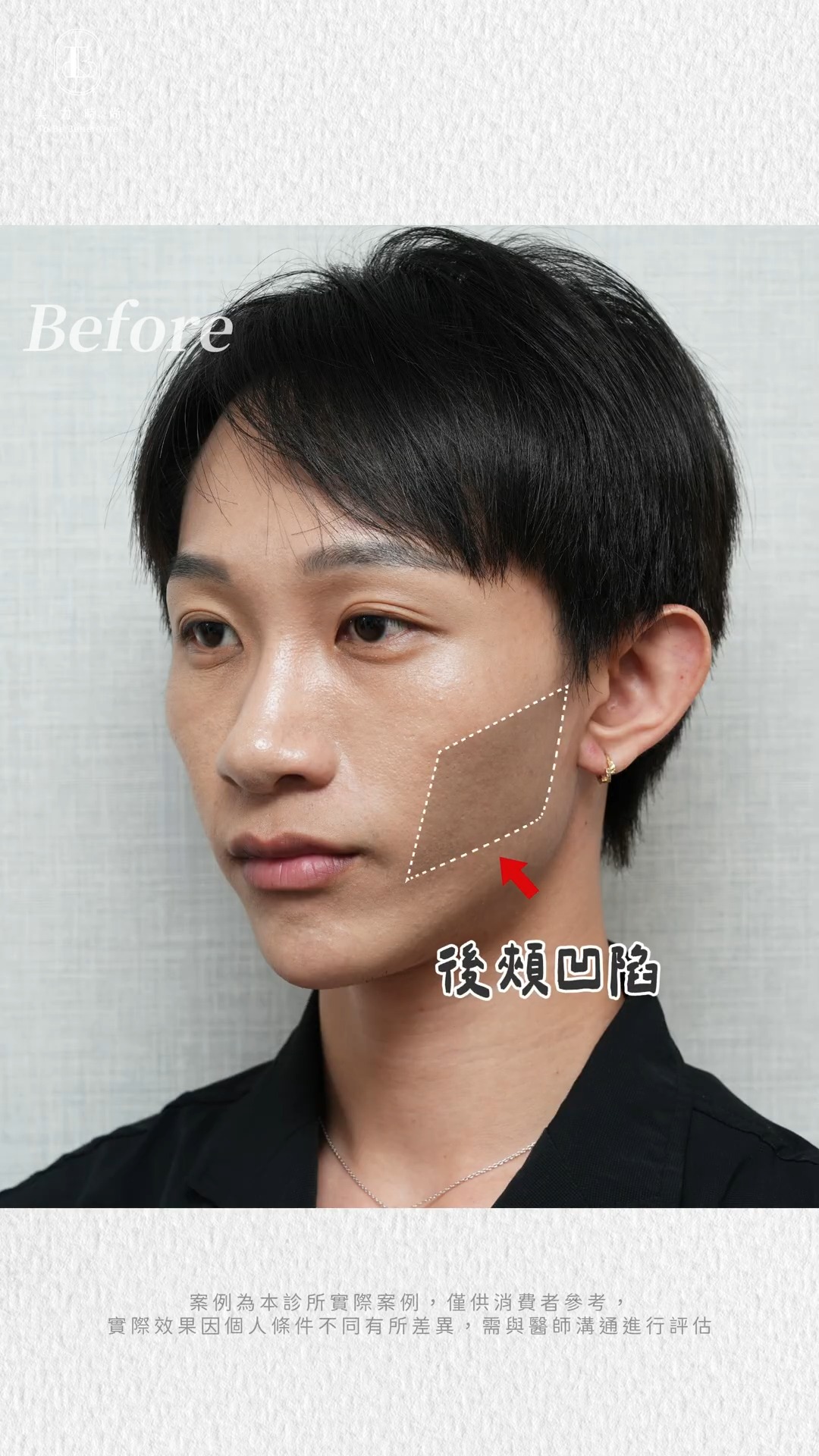 Raphael臉型困擾：臉部後頰凹陷