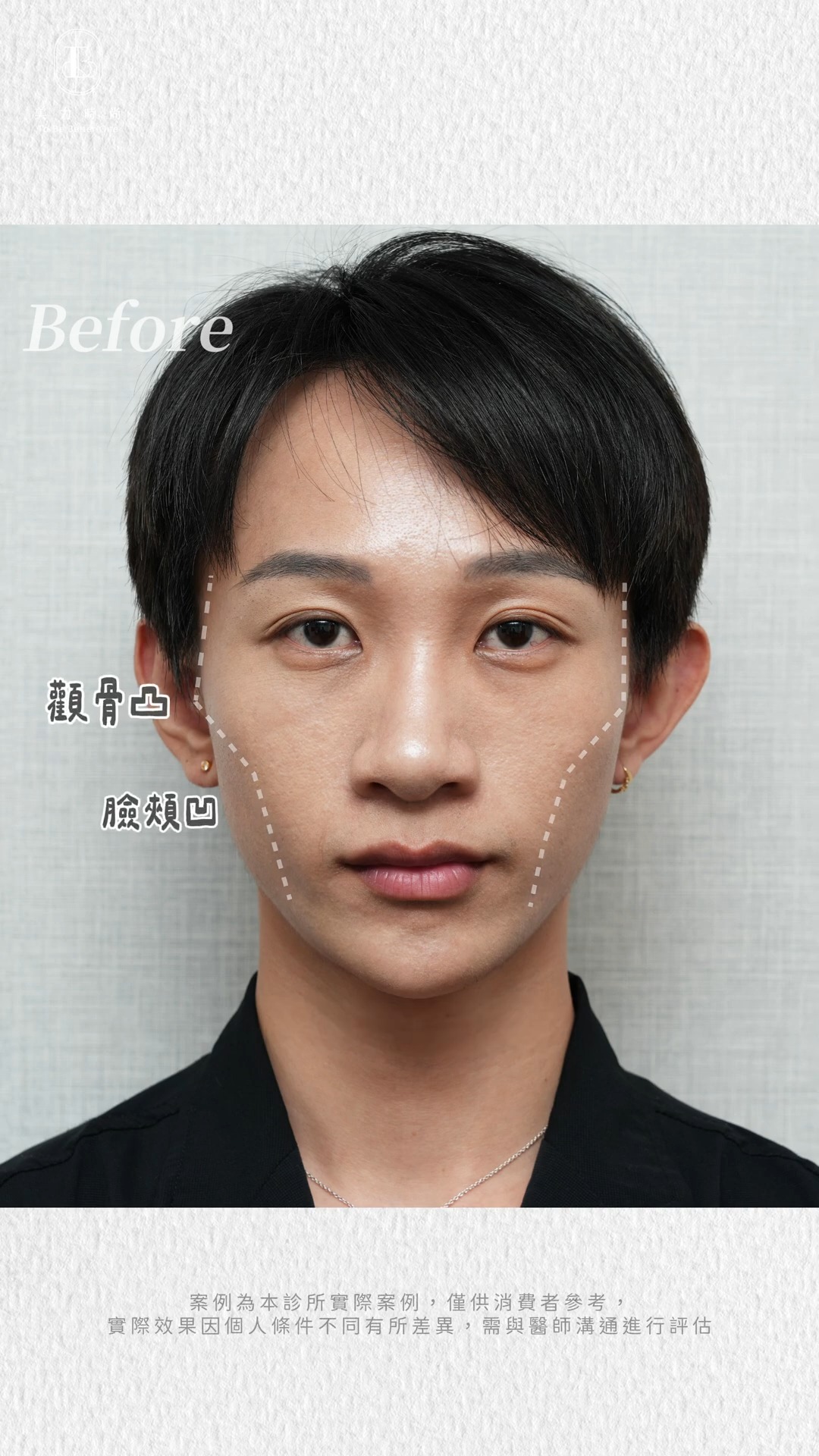 Raphael臉型困擾：顴骨突、臉頰凹陷