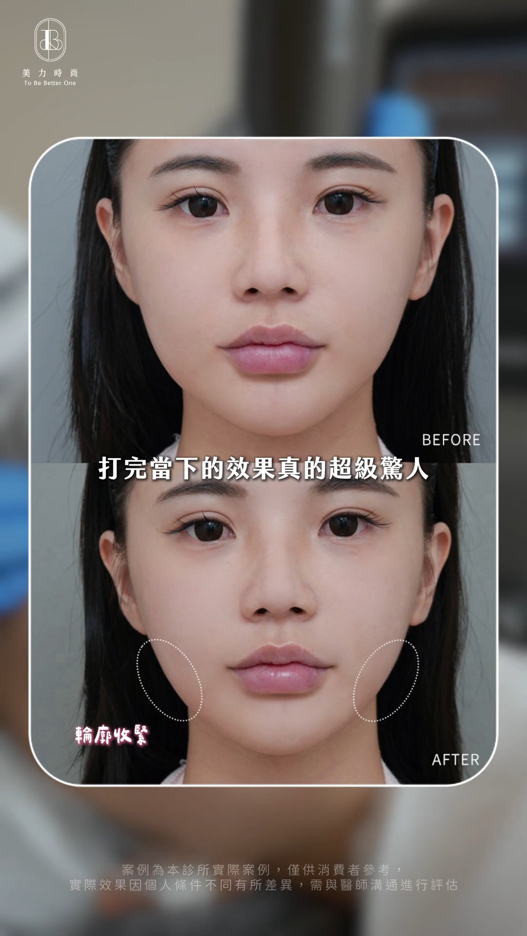 十蓓電波-Hannah_BA_最邊肉消失