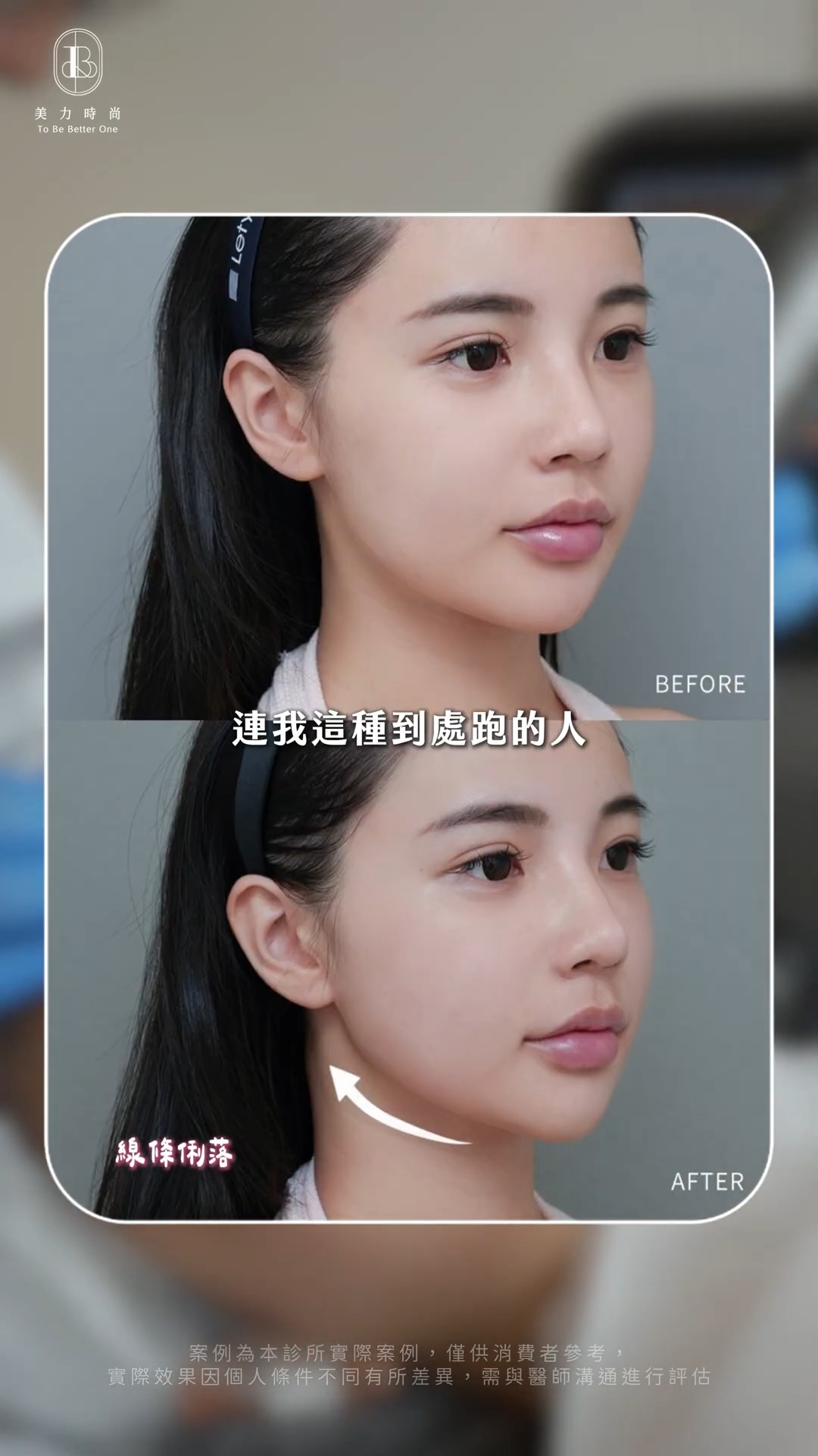 十蓓電波-Hannah_BA_輪廓拉提