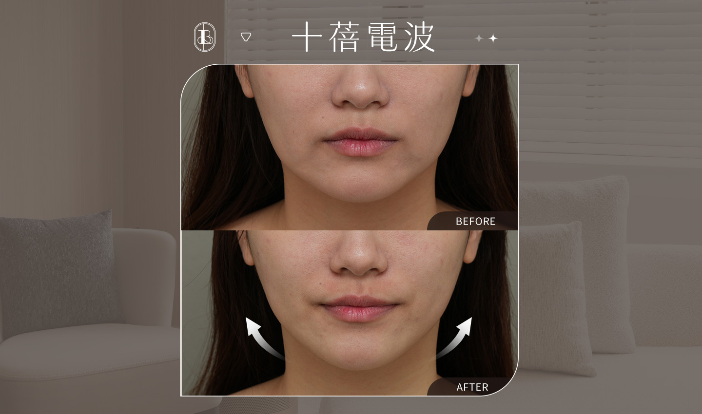 美力時尚診所案例：十蓓電波BA