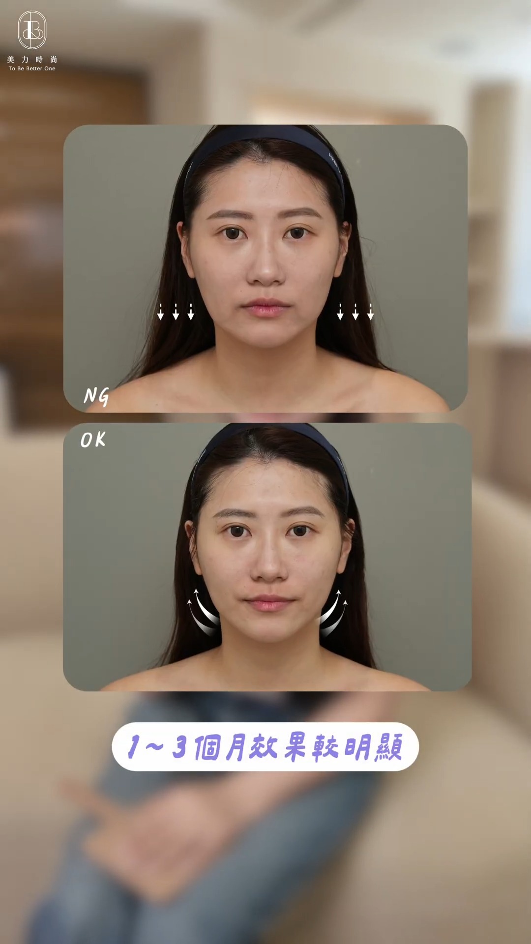 美力時尚診所案例：十蓓電波BA