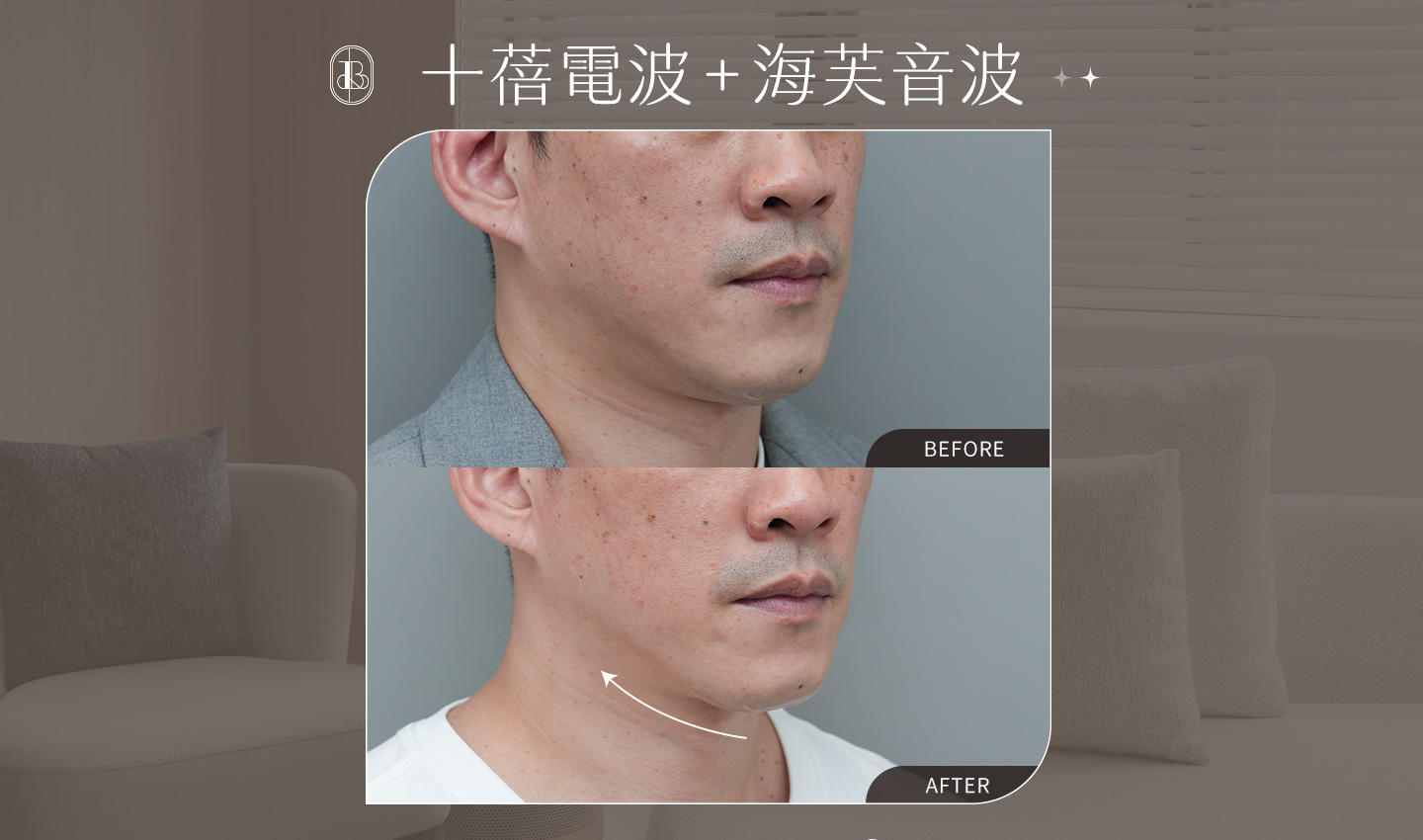 美力時尚診所案例：十蓓電波＋海芙音波BA