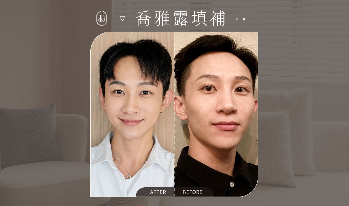 美力時尚診所案例：喬雅露填補BA_夫妻宮、頰凹、外輪廓修飾