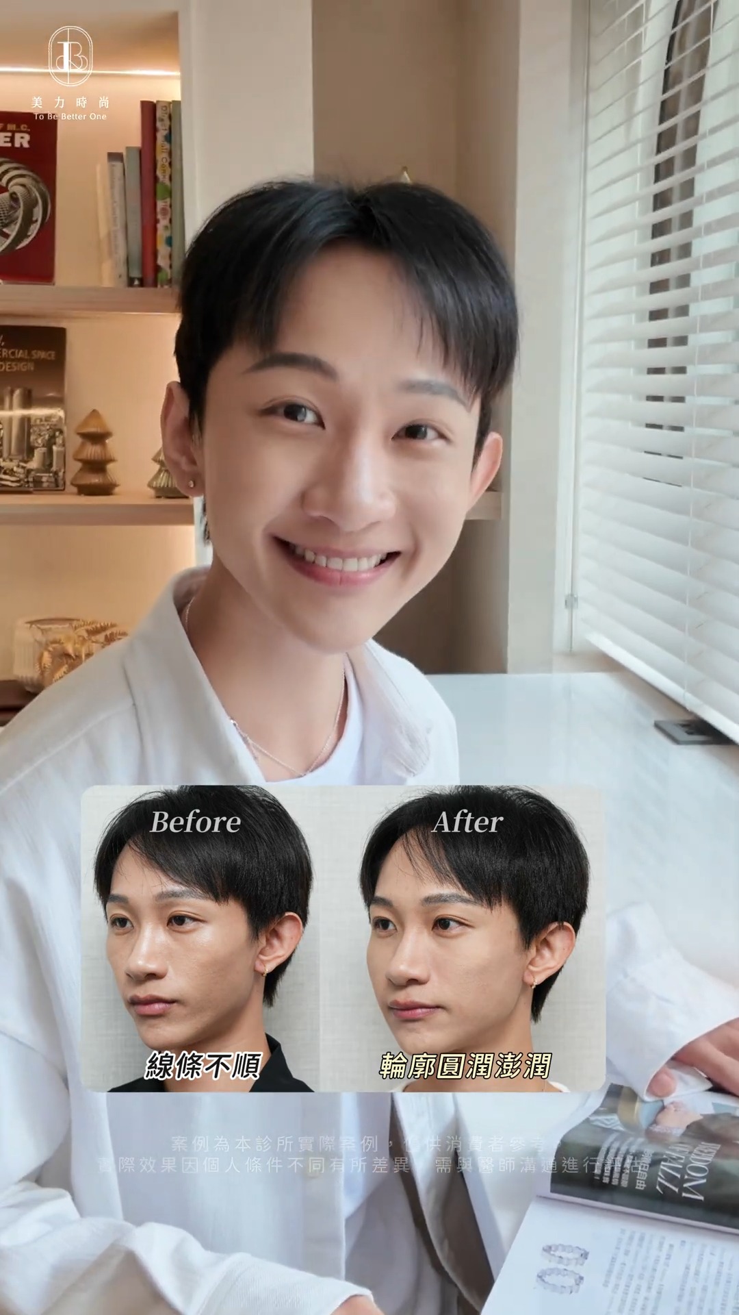 美力時尚診所案例：喬雅露填補Raphael_前後對比照