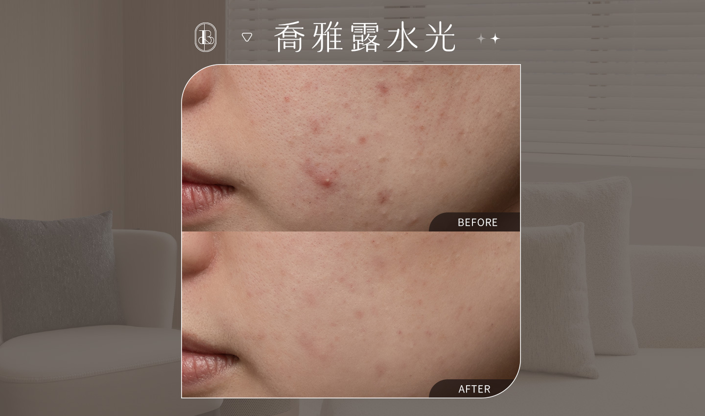 美力時尚診所喬雅露水光案例