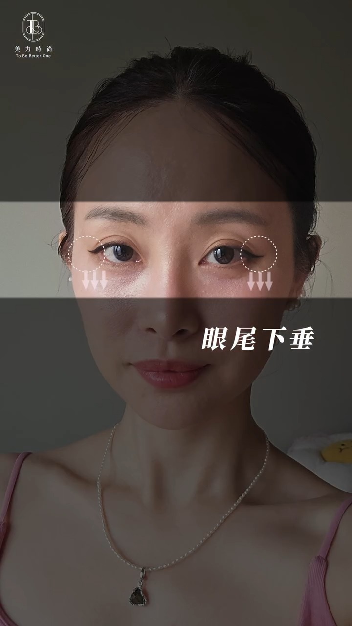 彤彤眼部困擾：眼周下垂、無神