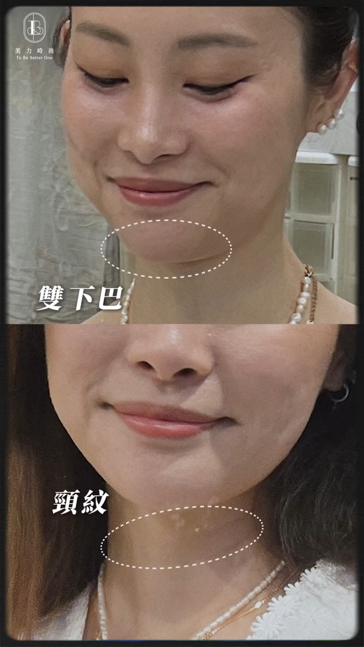 彤彤臉部困擾_雙下巴、頸紋