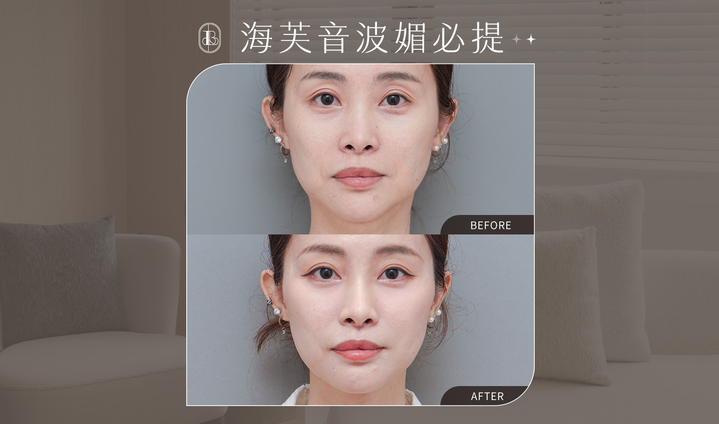美力時尚診所案例：海芙音波媚必提-彤彤