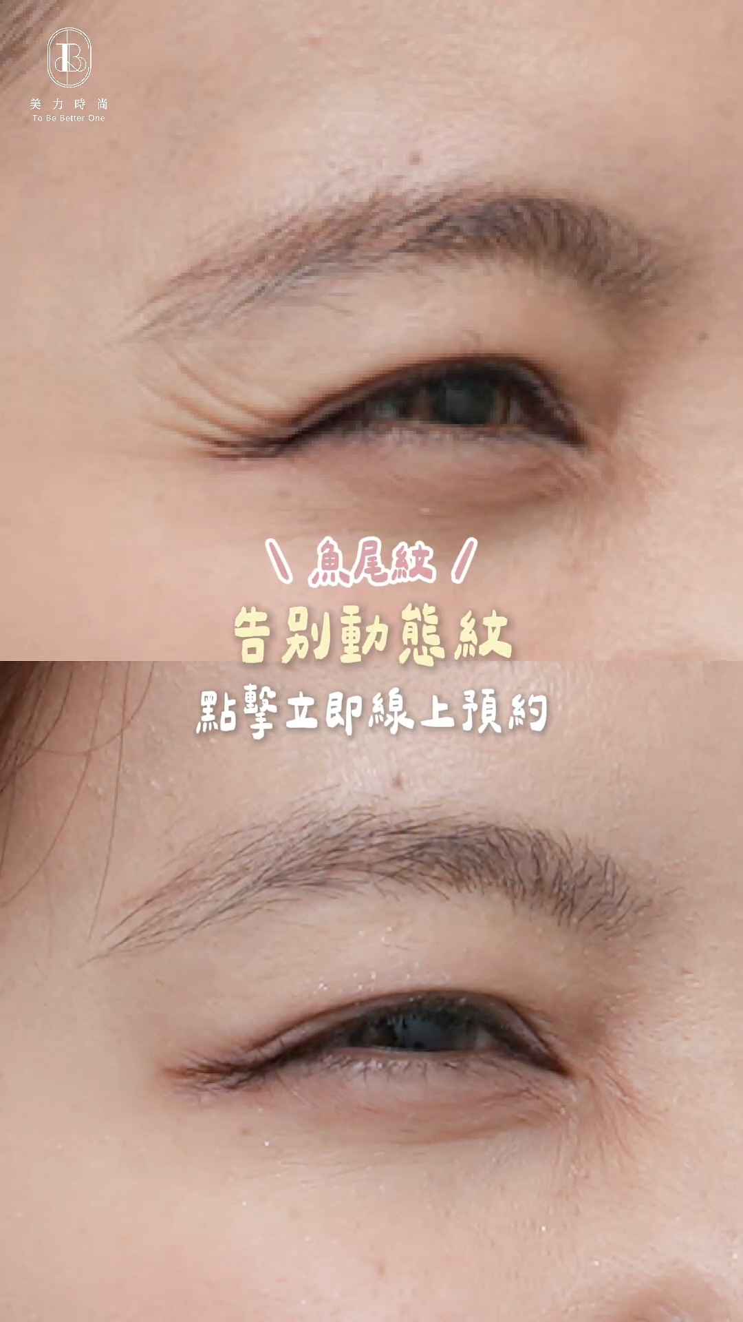 美力時尚診所：湘湘_肉毒魚尾紋BA