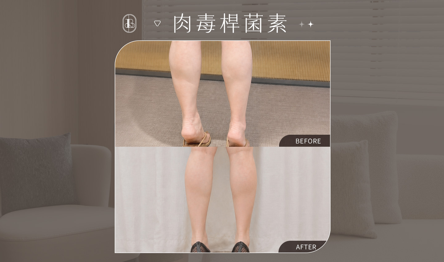 美力時尚診所：KOL Olivia肉毒小腿BA