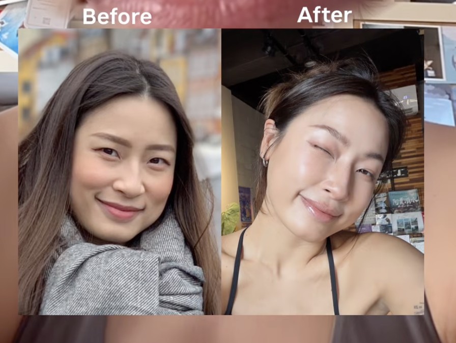 美力時尚診所：肉毒小臉BA