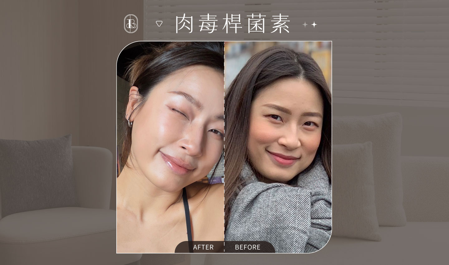 美力時尚診所，KOL kelly見證-咀嚼肌注射肉毒改善案例