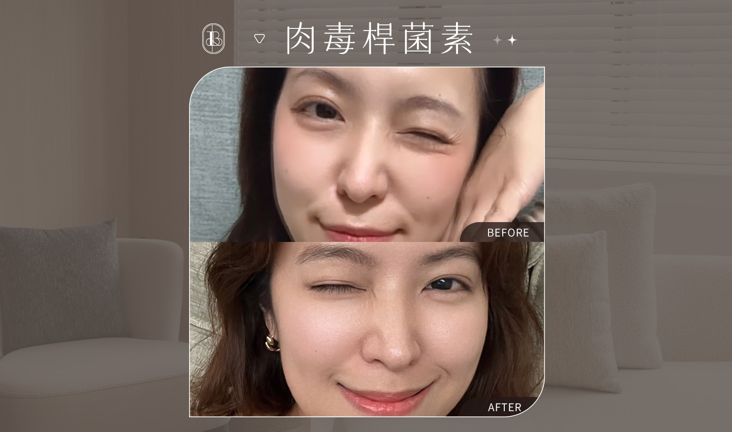 美力時尚診所肉毒除皺案例：動態紋三區BA