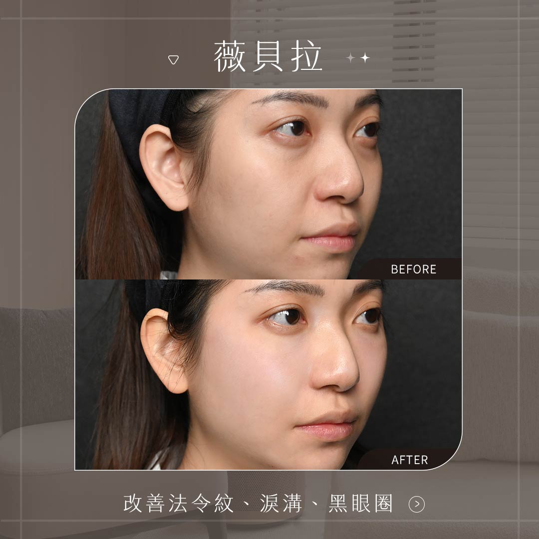 美力時尚診所薇貝拉案例：改善法令紋、淚溝、黑眼圈